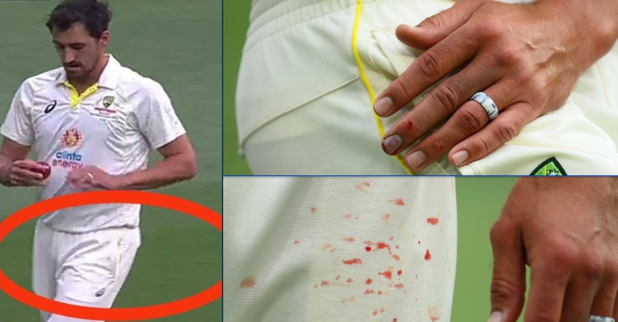 Mitchell Starc finger injury